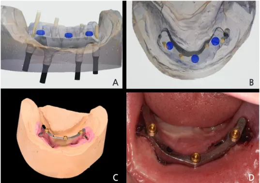 Fig. 6. Computer-aided design (CAD) and results of the implant-supported milled bar with 3 locators