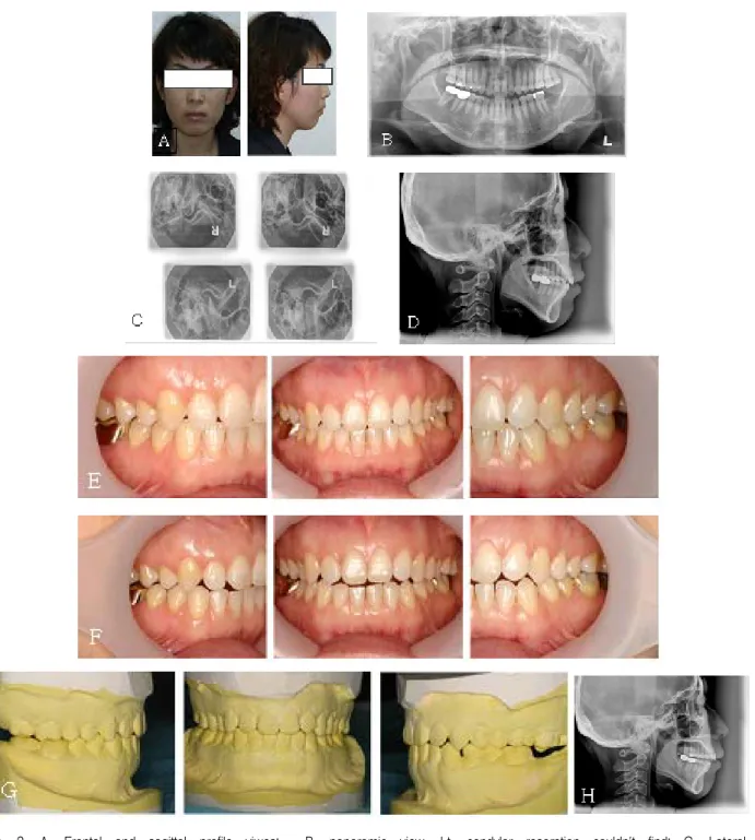 Fig.  2.  A,  Frontal  and  sagittal  profile  viwes;    B,  panoramic  view,  Lt.  condylar  resorption  couldn't  find;  C,  Lateral  transcranial  view,  Lt