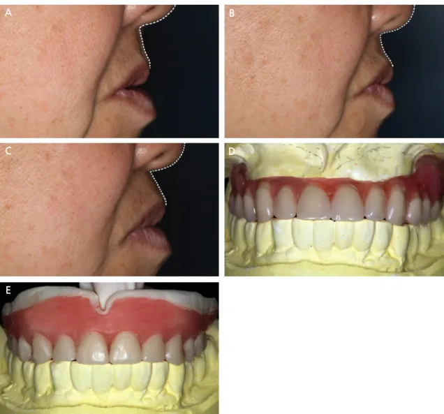 Fig. 2. Clinical evaluation of diagnostic trial denture from the lateral aspect. The dotted lines represent  lip support