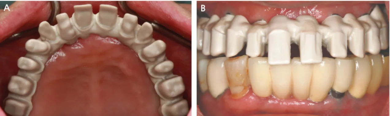 Fig. 5. Intraoral placement of polyetherketoneketone (Pekkton Ivory; Cendres+Métaux) framework