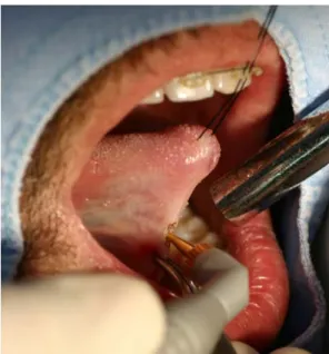 Fig.  6.  Incision  with  CO 2   laser