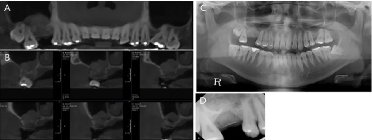 Fig. 3. Radiographic images immediately after the surgery. The grafted bone and the titanium mesh  were placed in harmony with the adjacent alveolar crest level