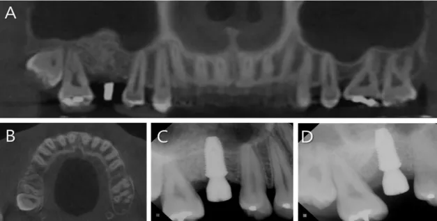 Fig. 5. (A) Seven months later, the bone was well healed to ensure proper bone height for implant  placement