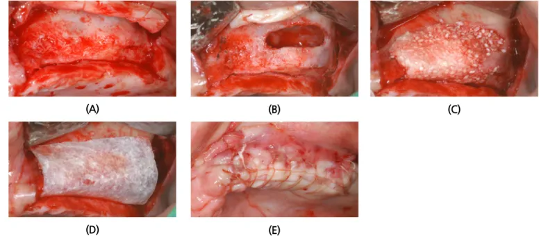 Fig. 3. Intraoral views of left sinus graft procedure with horizontal ridge augmentation