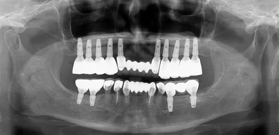 Fig. 5. Intraoral views of implant surgical procedure. (A)First surgery flap elevation, (B)Guide pins were  inserted, (C)Implnats were inserted, (D)Second surgery with healing abutment connection