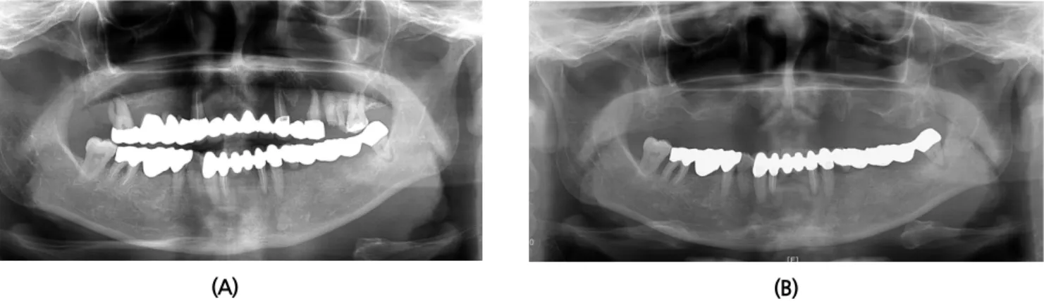 Fig. 7. Pre-operative panoramic view. (A)First visit, (B)Residual teeth were extracted.