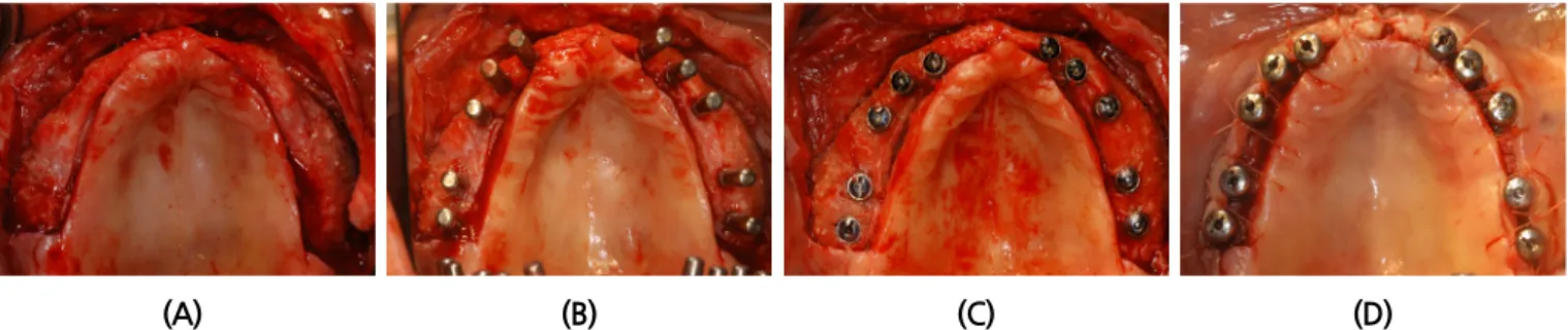 Fig. 10. Intraoral views of implant surgical procedure. (A)First surgery flap elevation, (B)Guide pins were inserted, (C)Implnats  were inserted, (D)Second surgery with healing abutment connection.