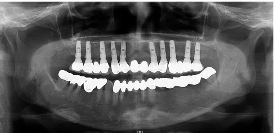Fig. 11. Panoramic view after final restoration setting.