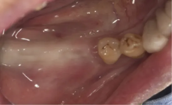 Fig. 1. Initial view of Mandibular posterior free-end implant case.