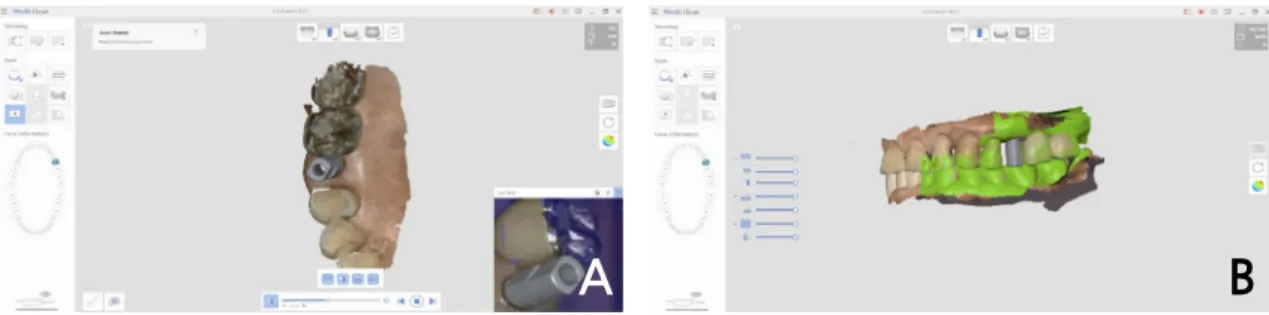 Fig. 9. Fabrication of metal coping: (A) Design using CAD software, (B) Metal-coping after finishing  metal printing.