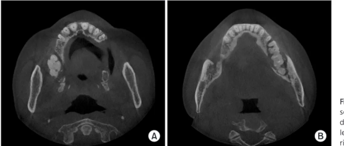 Fig. 1. Panoramic radiograph showing multiple diffuse densely  sclerotic lesions confused with roots before six years.