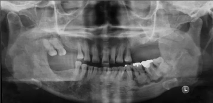 Fig. 3. Panoramic radiograph revealed sclerotic lesions confused  with root not separated and connected to each other surrounded  by wide osteolytic radiolucent lesions