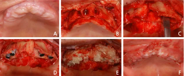 Fig. 2. Intraoral views of alveolar ridge split technique with guided bone regeneration