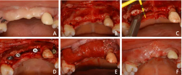 Fig. 7. Intraoral views of alveolar ridge split technique with guided bone regeneration