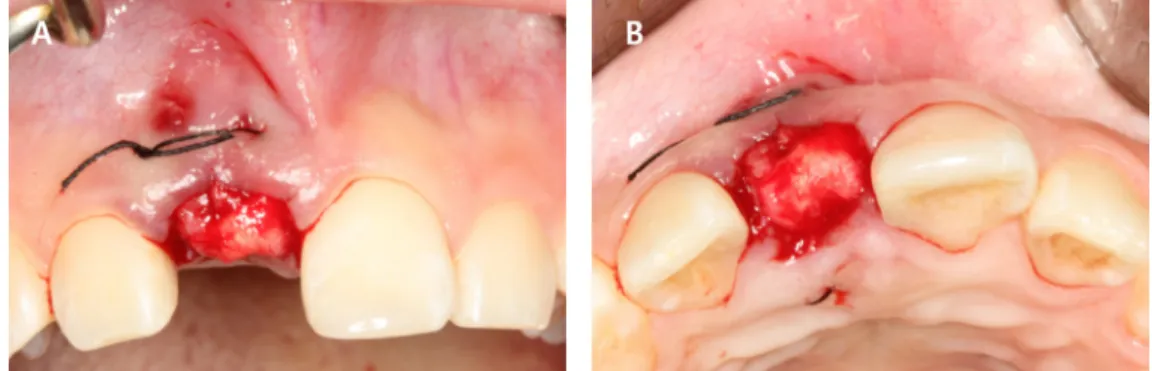 Fig. 2. Collagen sponge insertion into the extraction socket. (A) Labial view (B) Incisal view.