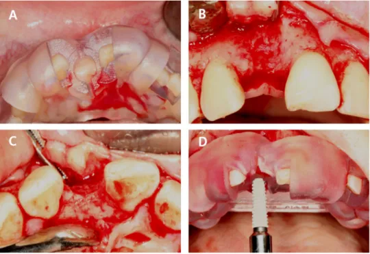 Fig. 4. One stage implantation with computer guided surgery (A) Surgical stent try-in (B) and (C) Flap  reflection-labial and incisal view (D) Implant placement with surgical stent.