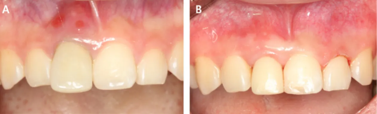 Fig. 7. Clinical comparision (A) Initial visit (B) Final restoration.