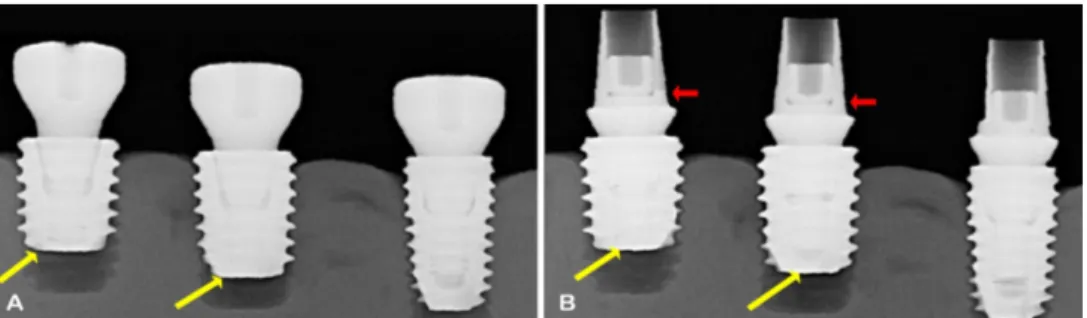 Fig. 13. In implants less than 7 mm long, the lower part of the screw contacts the inside of the implant