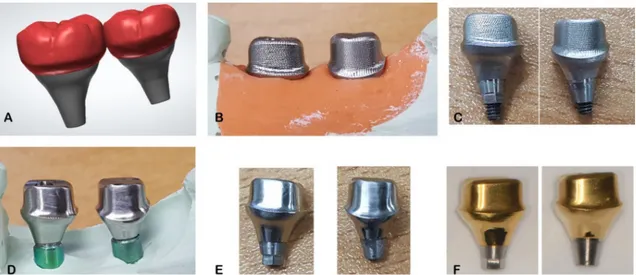 Fig. 1. Fabrication process of the CAD-CAM abutments. (A) Designing the CAD-CAM abutment and  (B) after milling