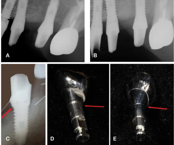 Fig. 4. (A) Misfit in the implant-abutment assembly during the first connection process