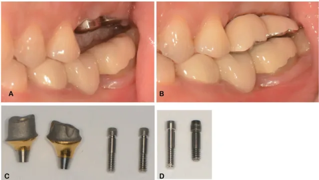 Fig. 6. (A) Patients visiting the hospital with a Dentis implant exhibiting a compatible connection with  the Osstem implant