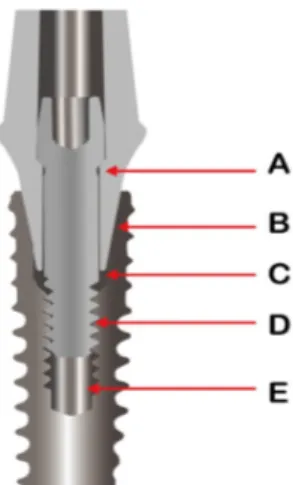 Fig. 8. (A) Old and new screws of the Osstem implant. (B) Interface between the old screw head  and abutment