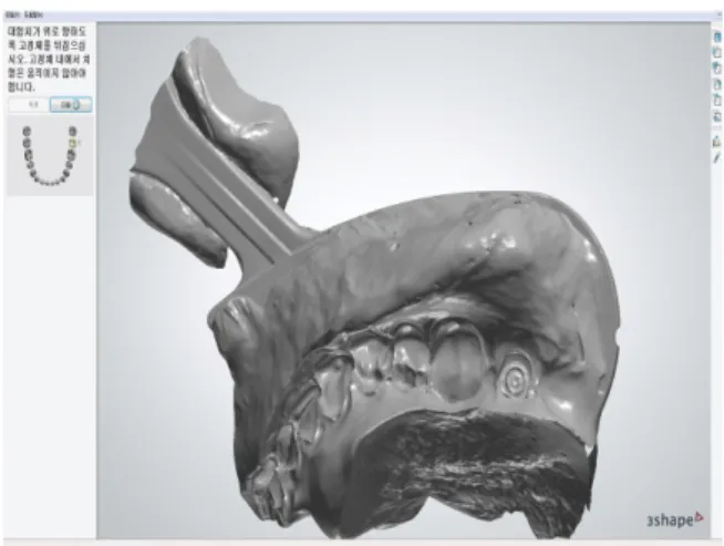 Fig. 3. Software view of the closed-mouth impression.