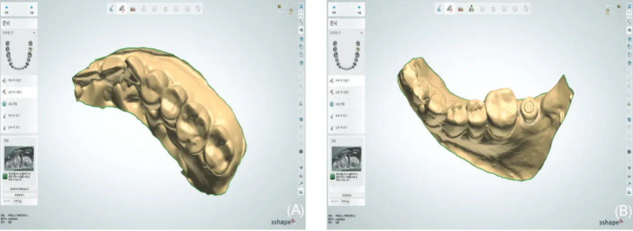 Fig. 6. Software view of scan data. A, Maxillary left dentition. B, Mandibular left dentition and scanbody.
