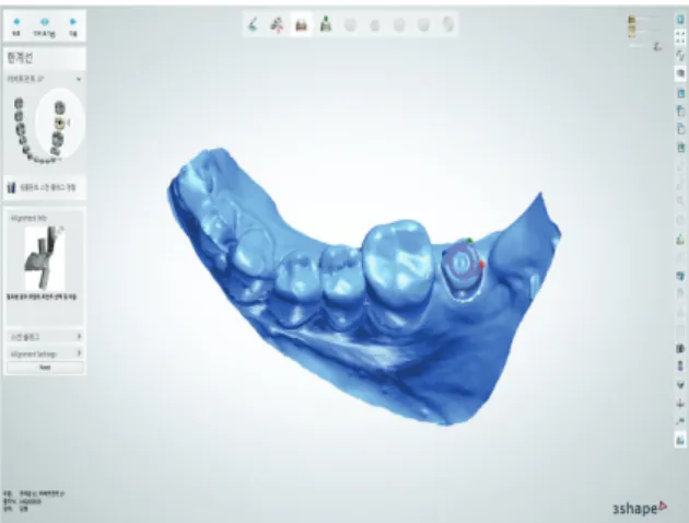 Fig. 8. Software view of the CAD design of an implant-supported crown.