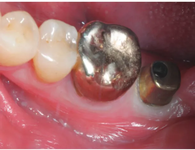 Fig. 11. CAD/CAM abutment in place.