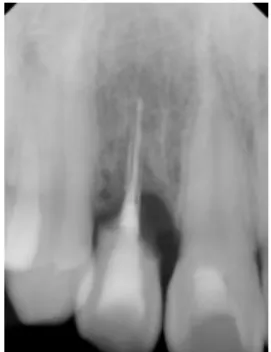 Fig. 1. Periapical radiograph exhibiting an external root resorption of the maxillary right lateral incisor.