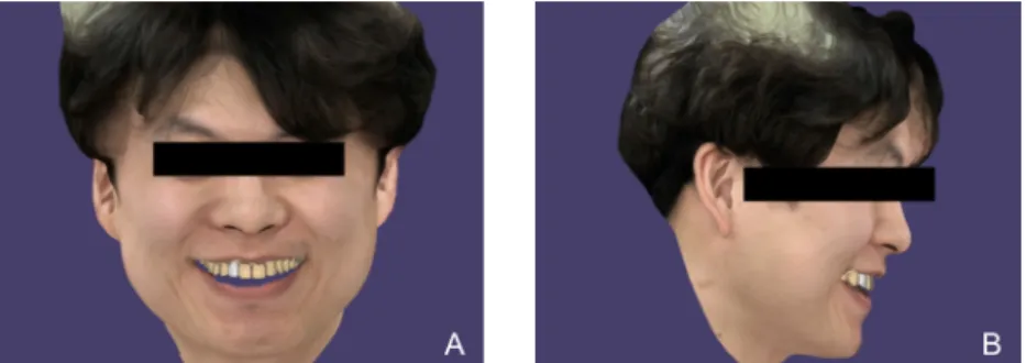 Fig. 4. Design of a definitive zirconia crown in the computer-aided design software (exocad DentalCAD; 