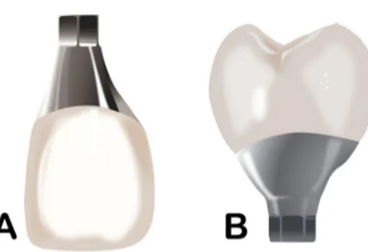 Fig. 15. Conversion of the gingival contact shape in a mesially installed implant. (B) Conversion type of the  gingival contact shape in a lingually installed implant