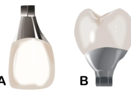 Fig. 15. Conversion of the gingival contact shape in a mesially installed implant. (B) Conversion type of the  gingival contact shape in a lingually installed implant