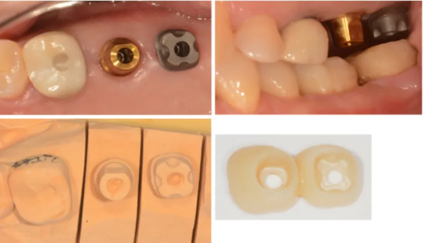 Fig. 4. When the vertical restoration space was insufficient, a CAD-CAM abutment was designed to have  retention grooves on all four walls.
