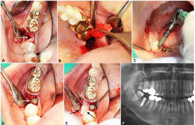 Fig. 2. A. An intraoral view of the alveolar ridge defect after full-thickness flap elevation (marked by arrow), B