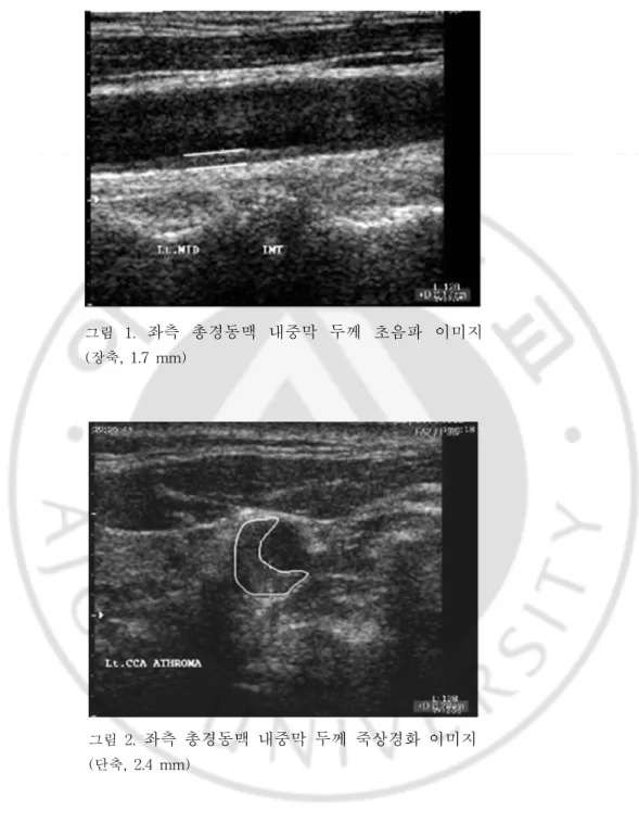 그림  2.   좌측  총경동맥  내중막  두께  죽상경화  이미지 (단축,  2.4  mm)