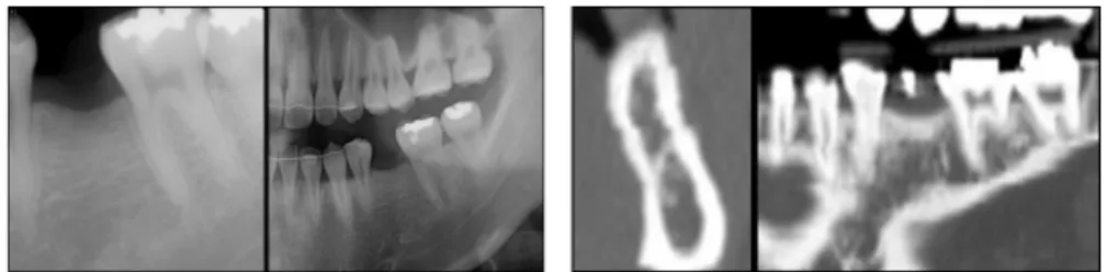 Fig. 1. Periapical, panoramic, reformatted cross sectional and reformatted panoramic view of missing  tooth area.