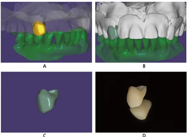 Fig. 6. Finalized retro-fitted crown restoration. A: Final design of the virtual crown in lateral view
