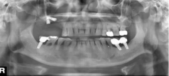 Fig. 1. First visit Panorama. #15,16 implants are into the maxillary sinus. The #14 natural teeth  observated bone resorption on the distal side and the #46 is excessive erupted.