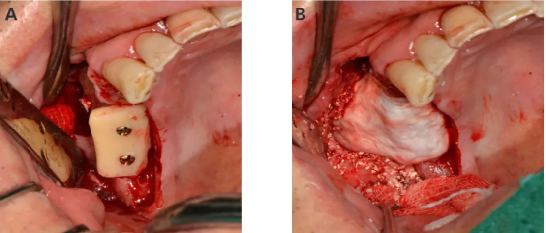 Fig. 4. Panorama Immediately after bone augmentaion. Immediately after bone augmentation