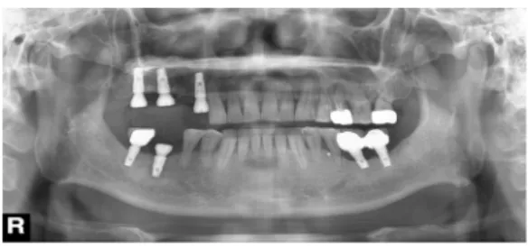 Fig. 8. 6month panorama after prosthesis delivery.