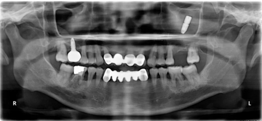 Fig. 1. The initial panoramic radiography showed that the displacement of the implant in the left  maxillary sinus, and left maxillary sinusitis.