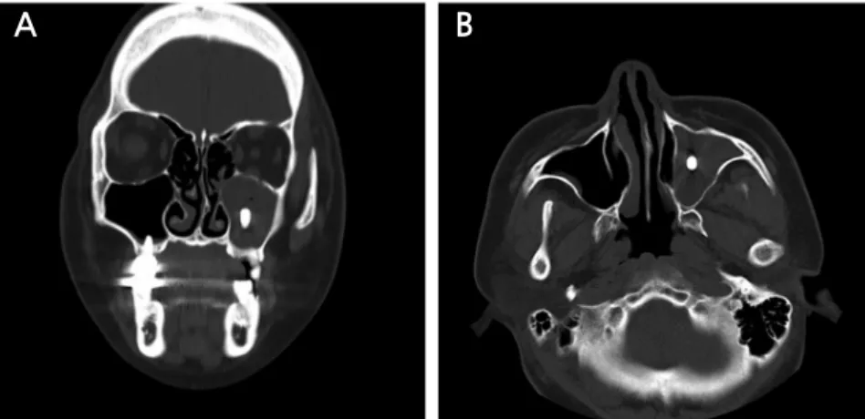 Fig. 3. The discharged implant which was displaced into left maxillary sinus.