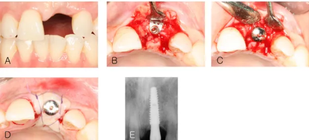 Fig. 9. Clinical photograph at the second stage of implant surgery. (A) Labial view before surgery, (B) After flap elevation,  (C) After healing abutment connection, (D) Suture, (E) Periapical x-ray after the second stage of implant surgery.