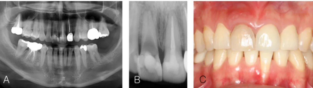 Fig. 2. At first visit. (A) Panoramic view x-ray, (B) Periapical x-ray, (C) Clinical photo, the color of tooth 