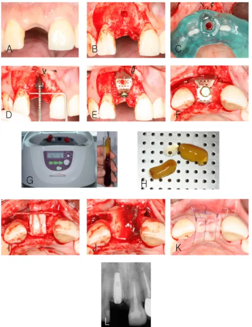 Fig. 4. Clinical photograph at the first stage of implant surgery. (A) Labial view before surgery, (B) After flap elevation, (C)  Surgical stent positioned on #11, (D) Labial dehiscence after implant placement, (E) Labial view after application of bone  gr