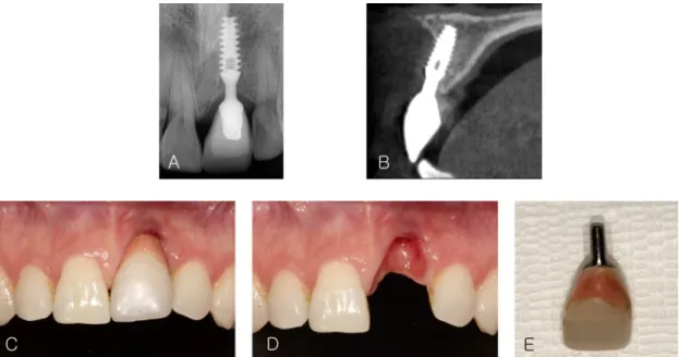 Fig. 7. (A) Periapical x-ray, (B) CBCT sagittal view on #21 implant, (C) Clinical photograph on the labial view, (D) Clinical  photograph on the labial view after removal of the prosthesis, (E) Removed prosthesis.