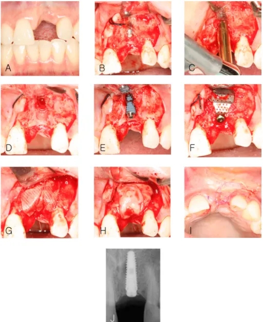Fig. 8. Clinical photograph at removal of failed implant and first stage of implant surgery