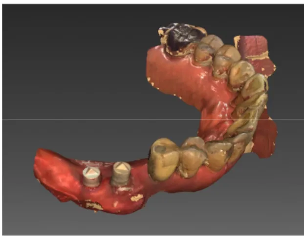Fig. 4. Digital scanning using CEREC Omnicam.